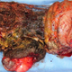 The “twin” tumor, taken out of the girl’s body.